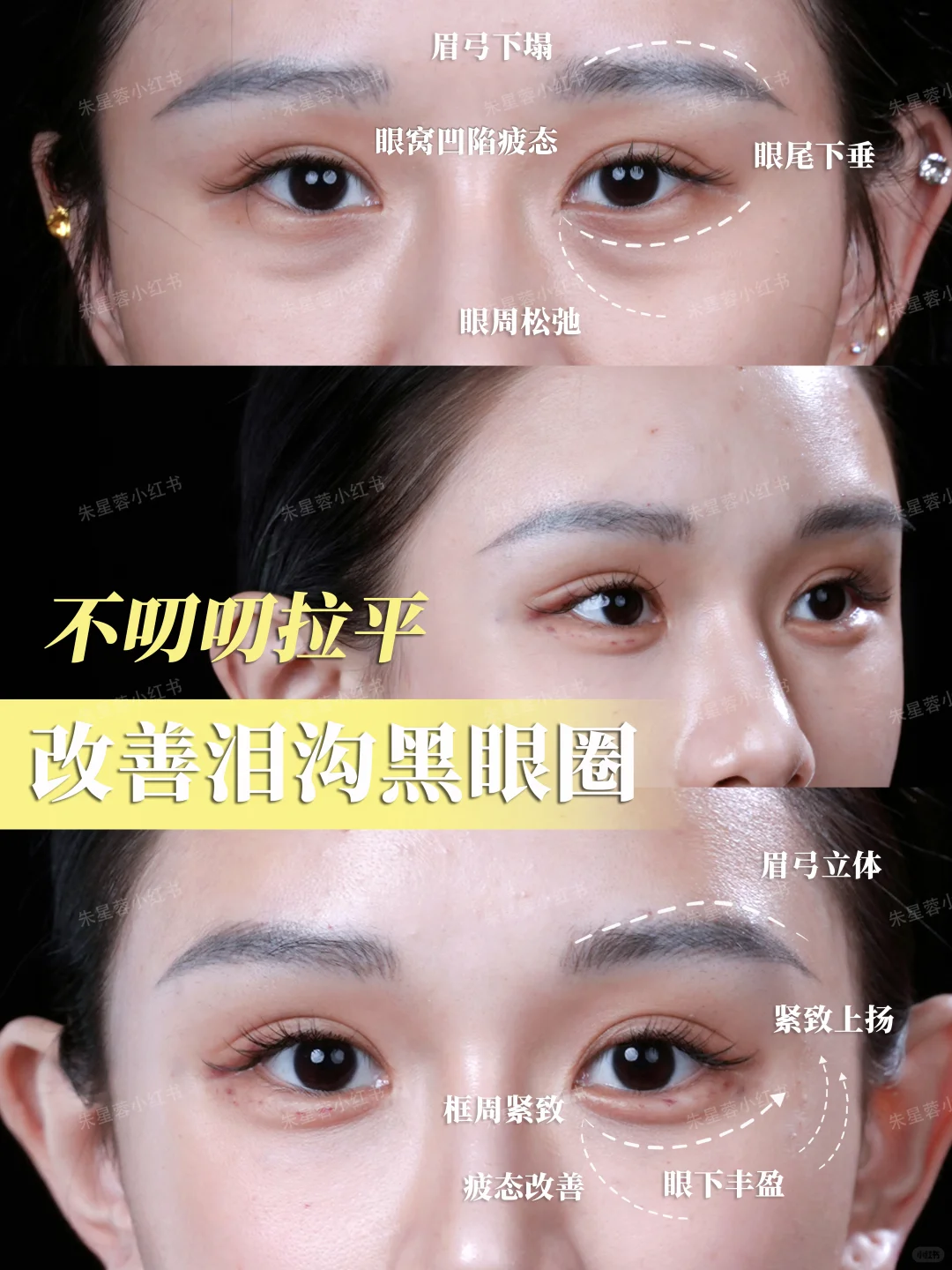眼周年轻化｜小剂量精细微调 1
