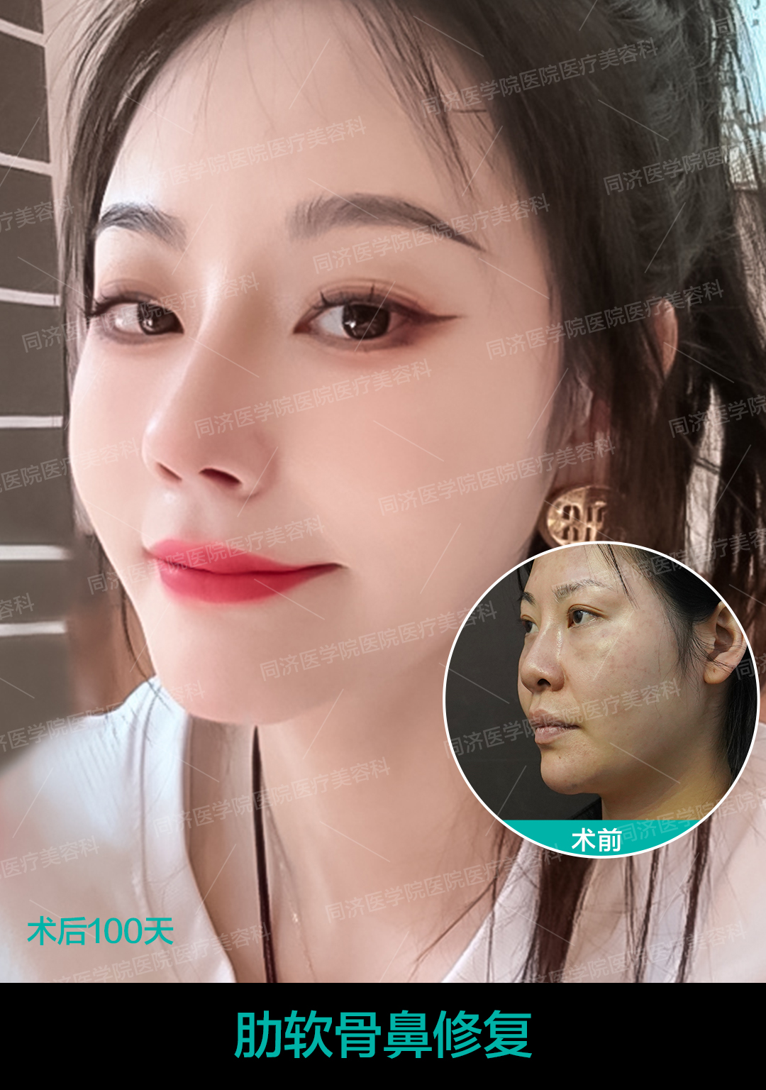 肋软骨鼻修复 1