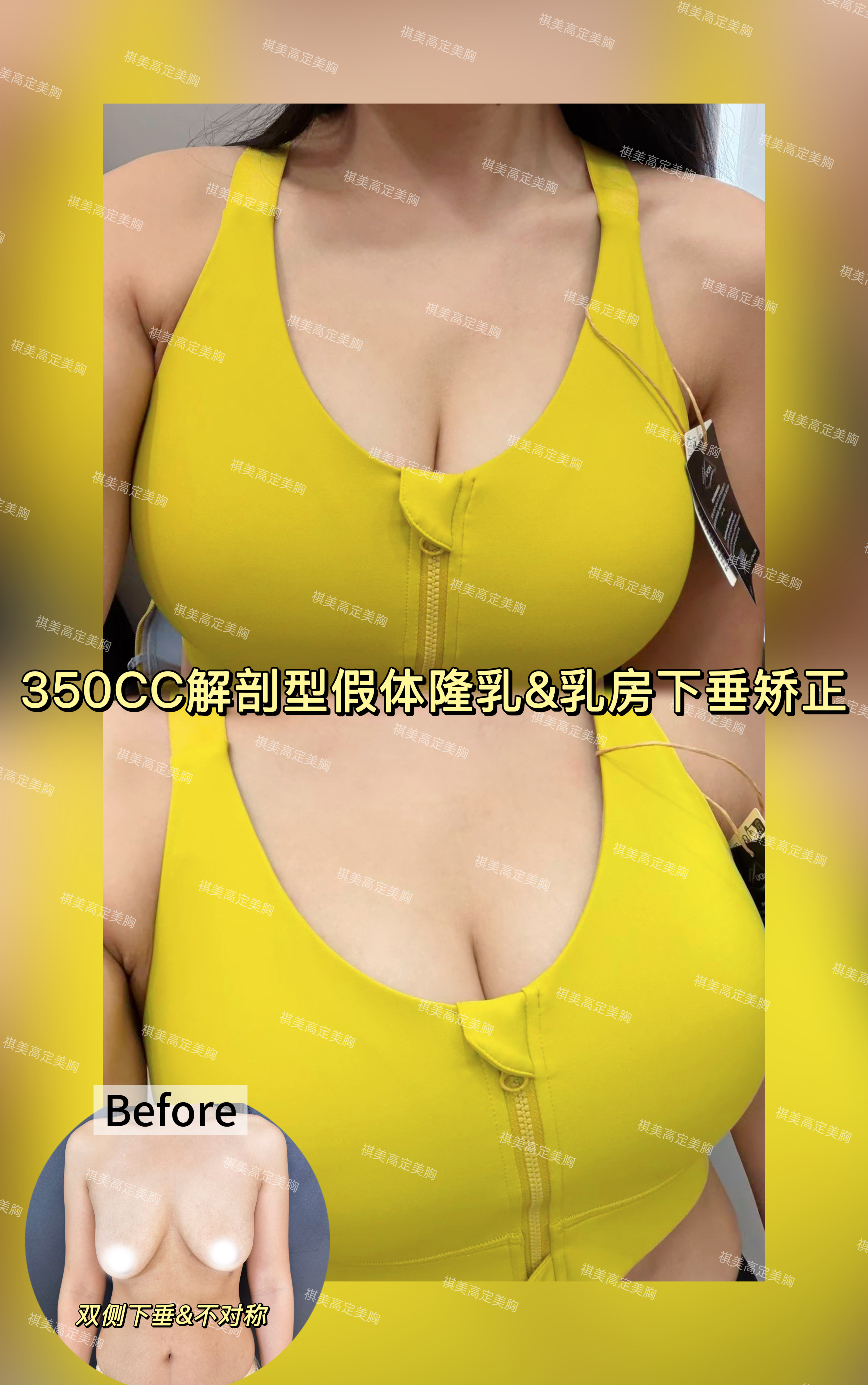 乳房下垂矫正 1