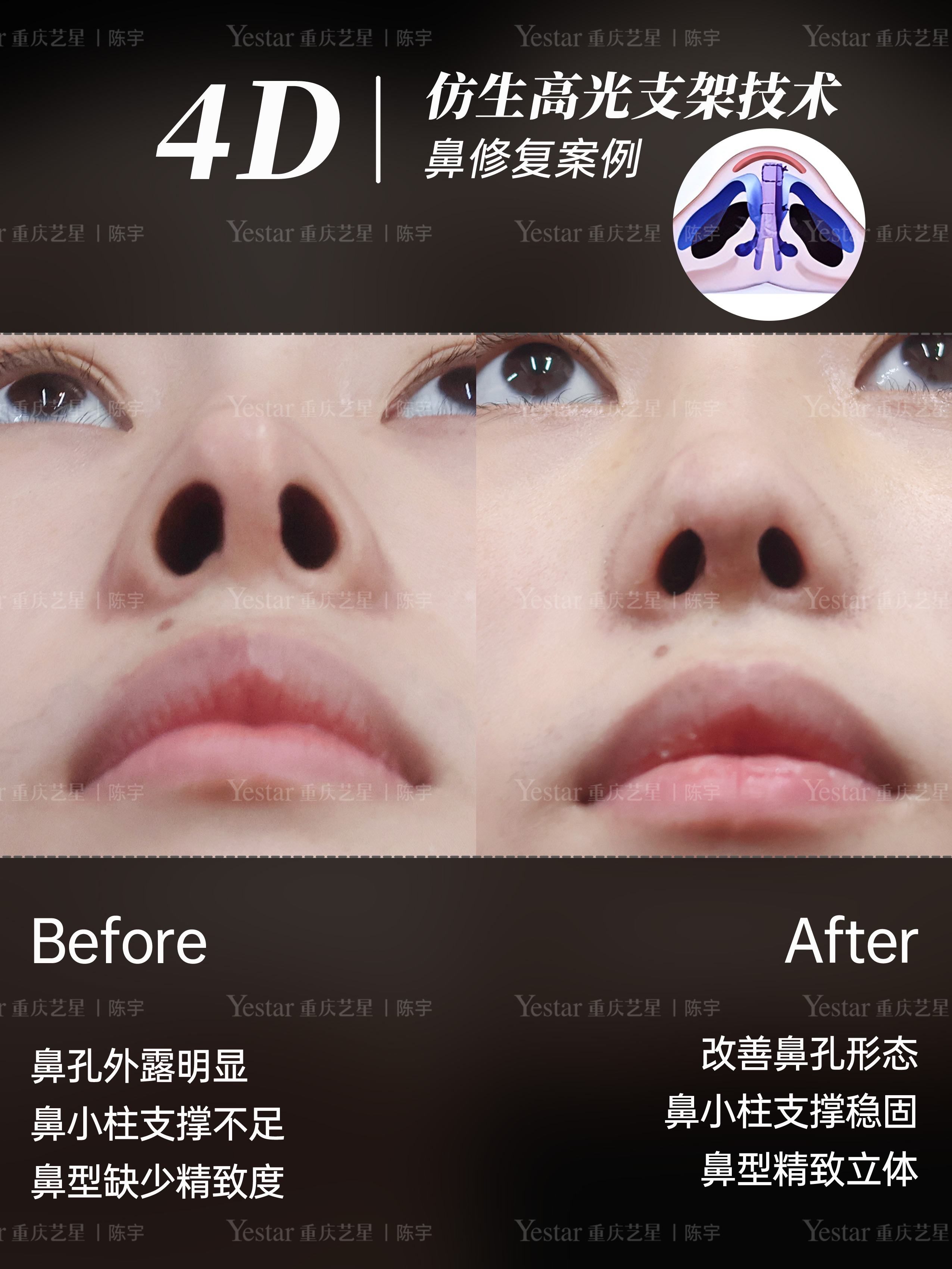 膨体肋骨鼻修复👃 2