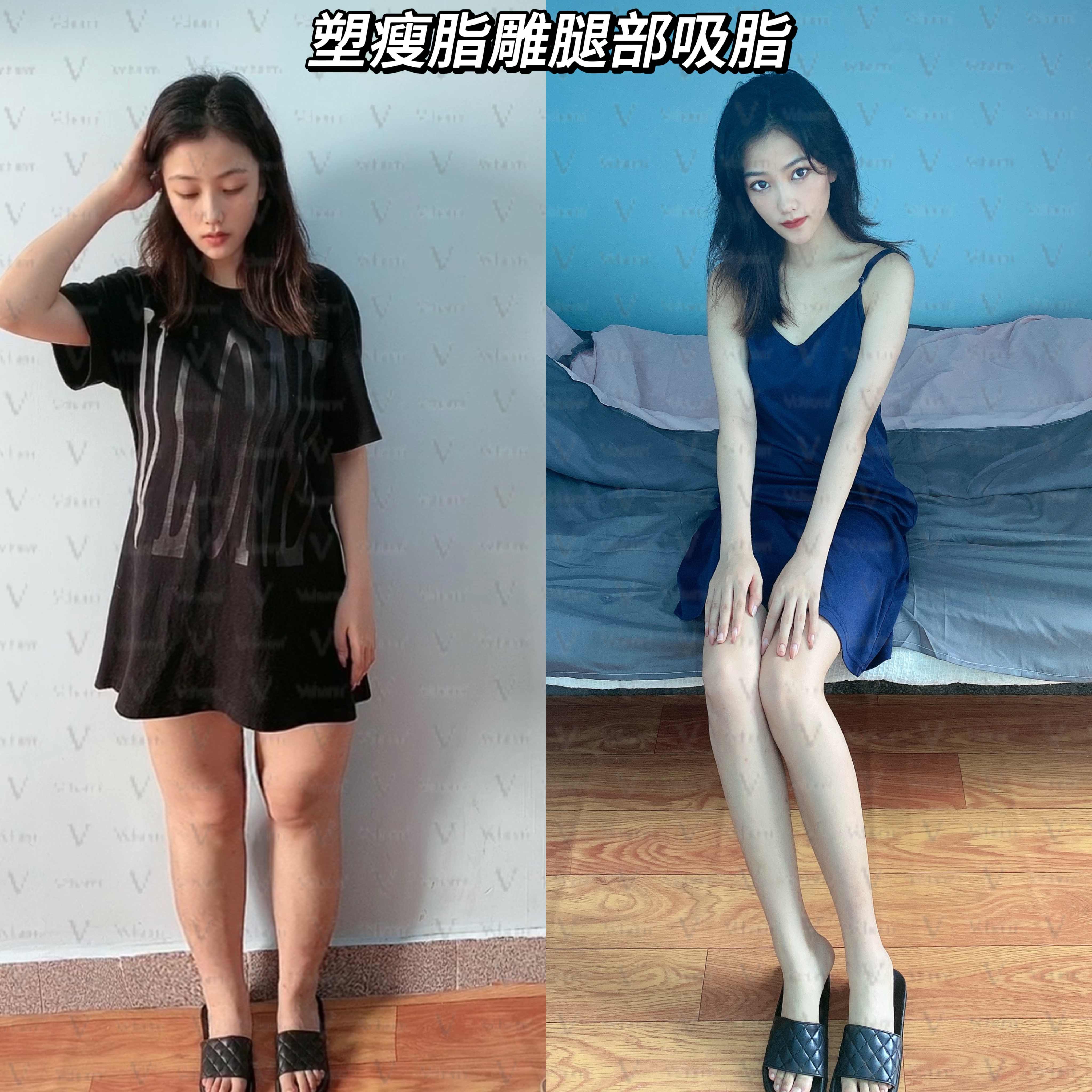 37℃恒温吸脂