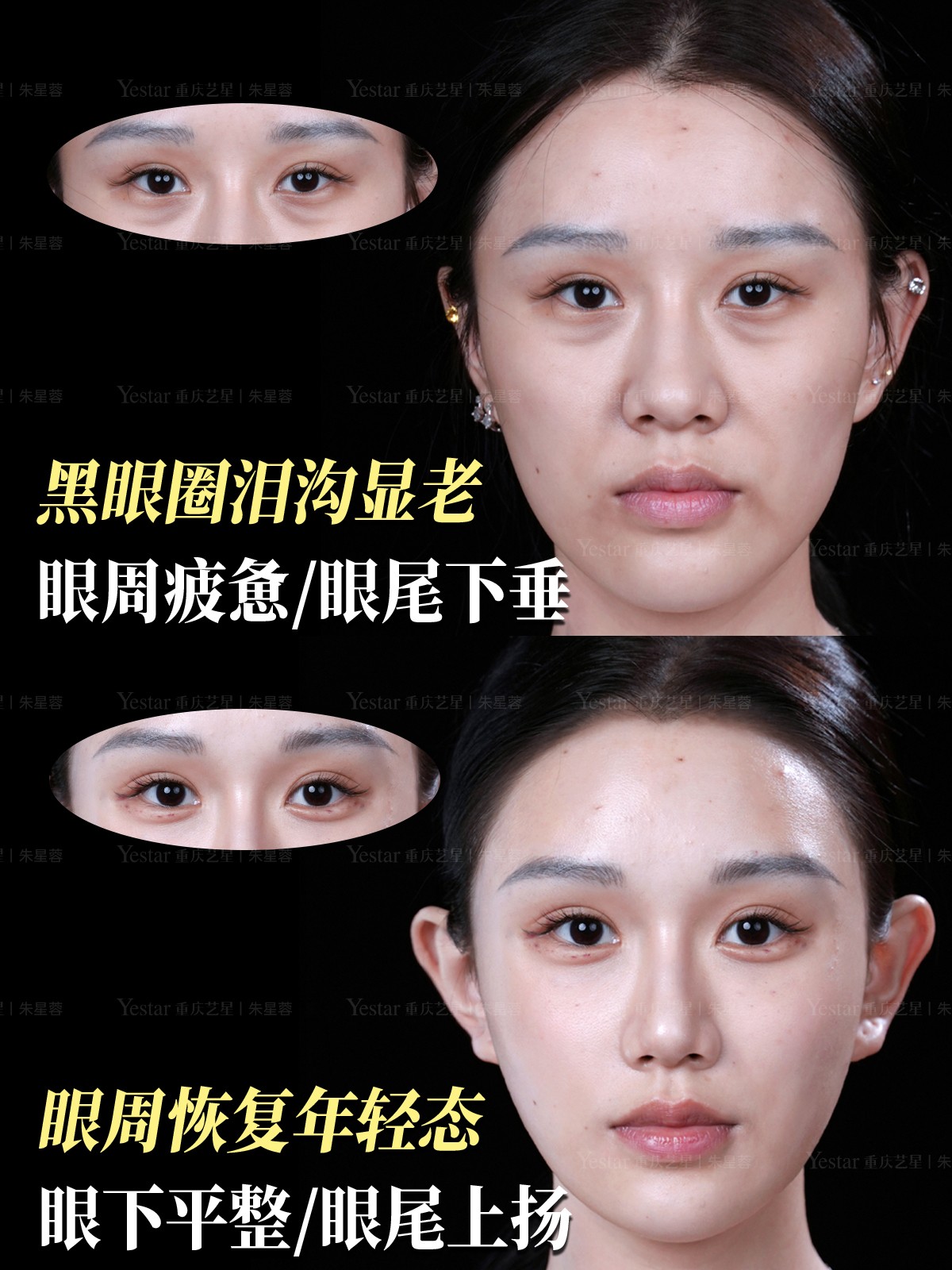 泪沟凹陷到底该怎么解决❓ 1