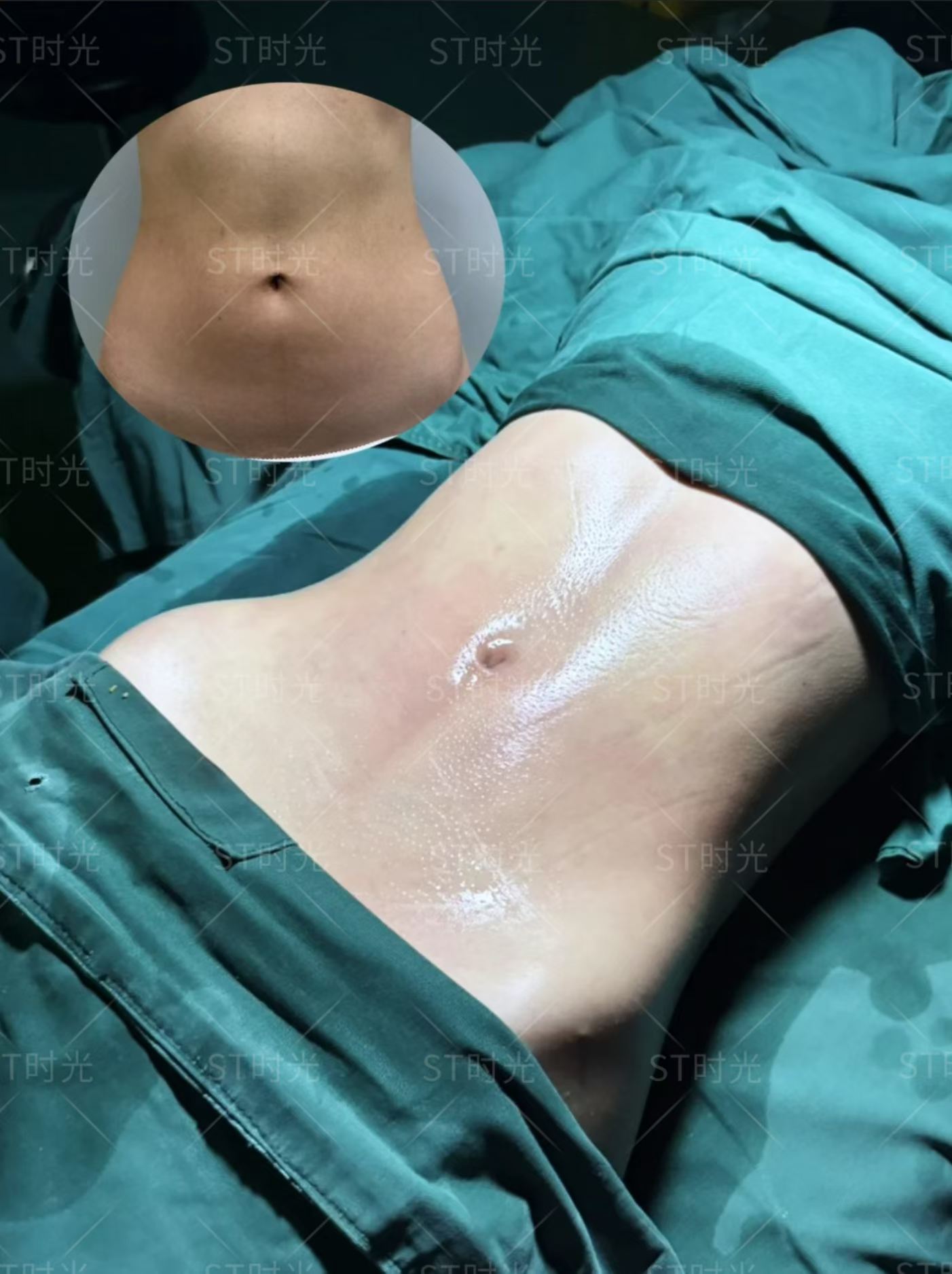 腰腹吸脂，即刻对比 1