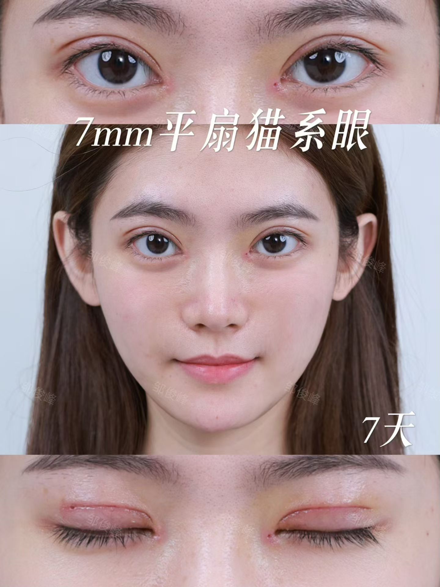 平扇术后7天拆线和术后一个月对比 1