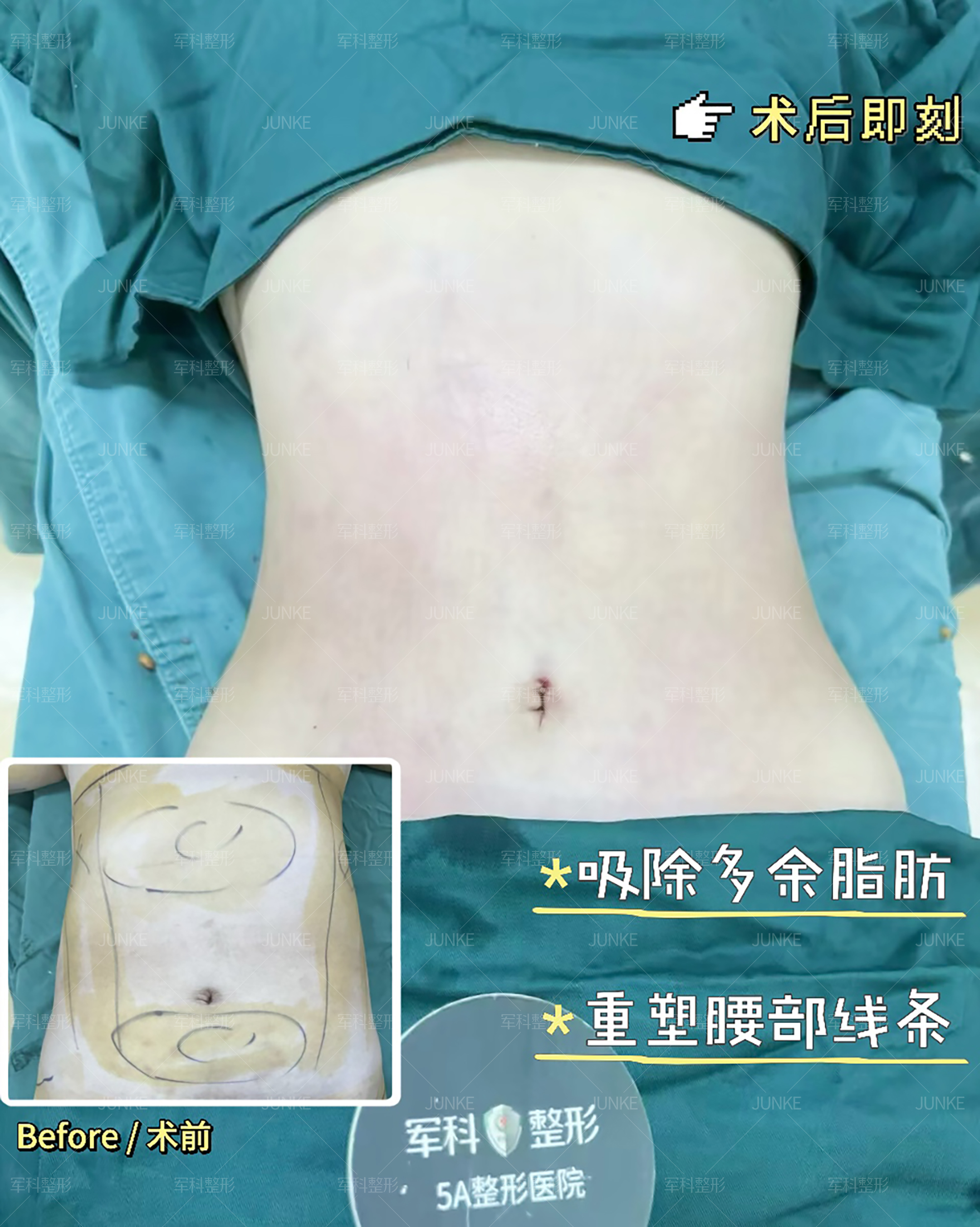 腰腹术前vs术后即刻✨ 1
