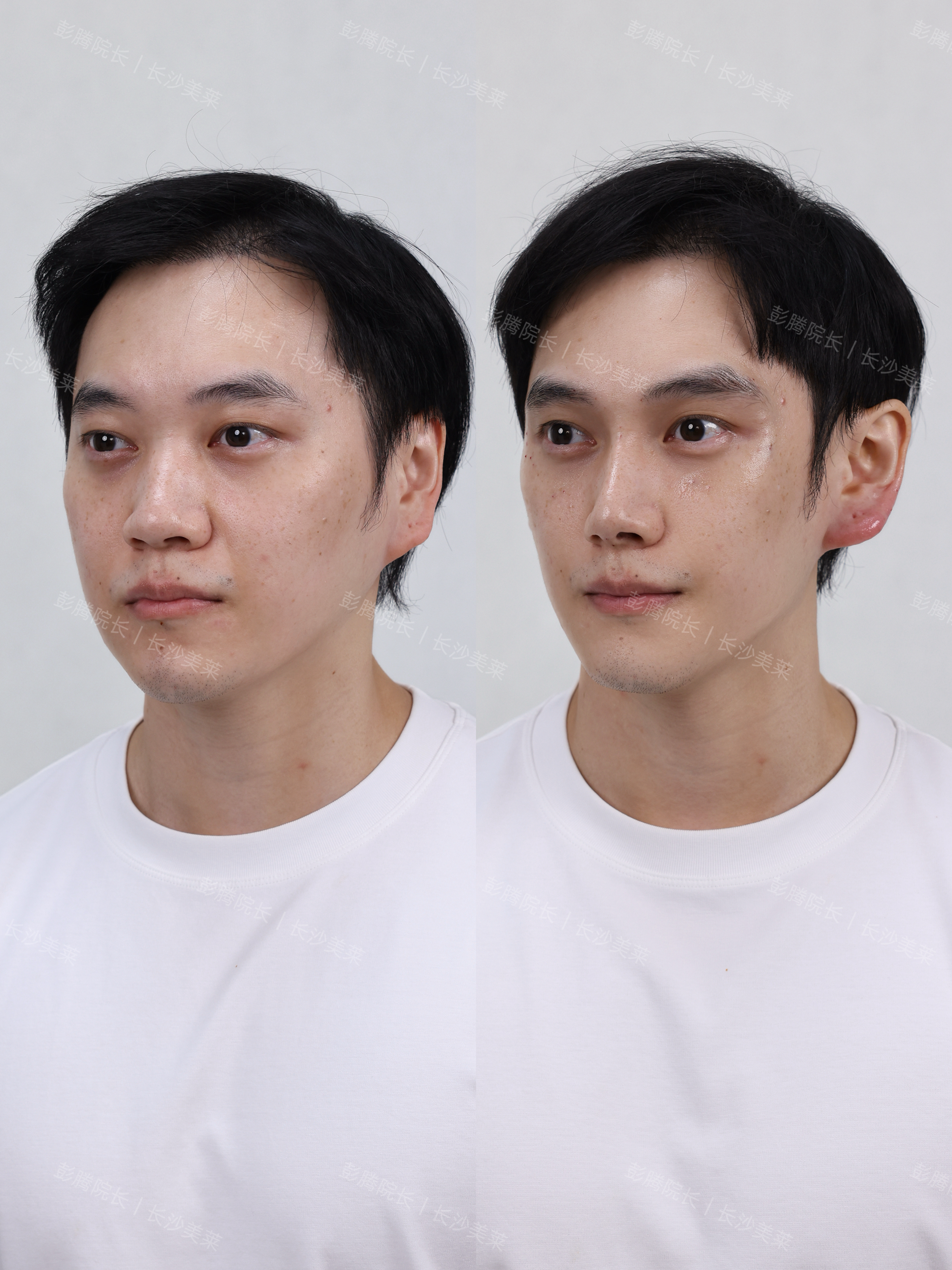 男生骨相微调 2