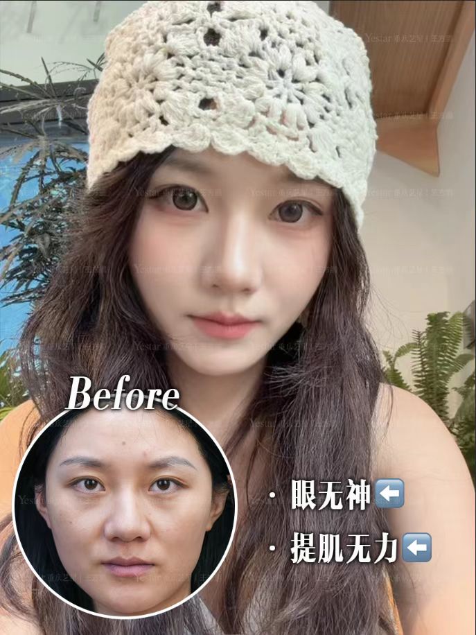 5.0动态重睑 | 自然放大双眼 1