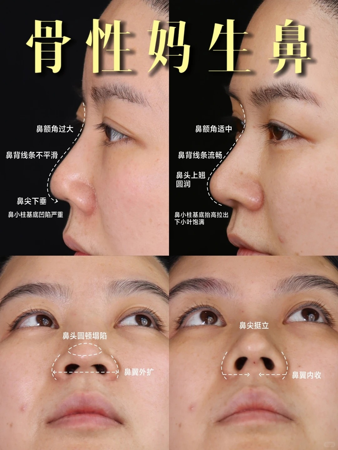 注射隆鼻自然改善 1