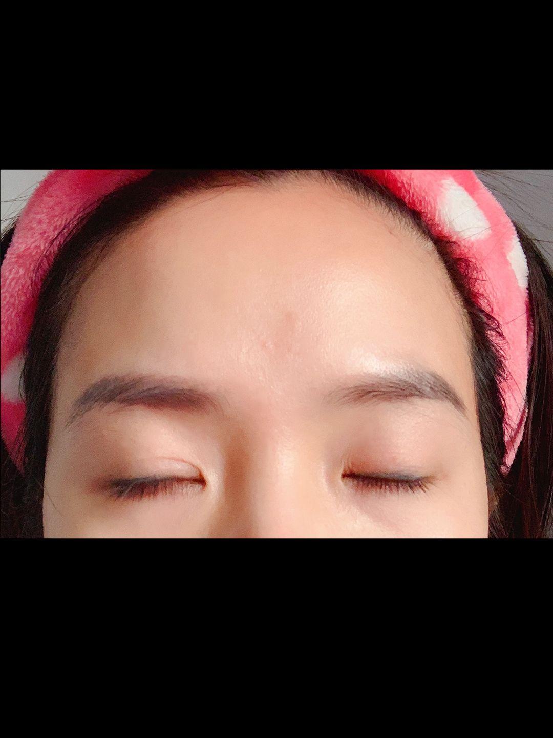 上睑下垂矫正恢复记录。 12