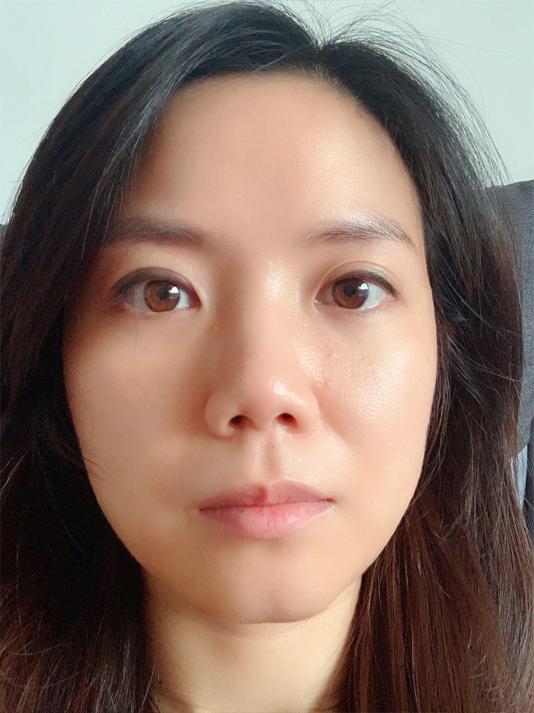 上睑下垂矫正恢复记录。 7